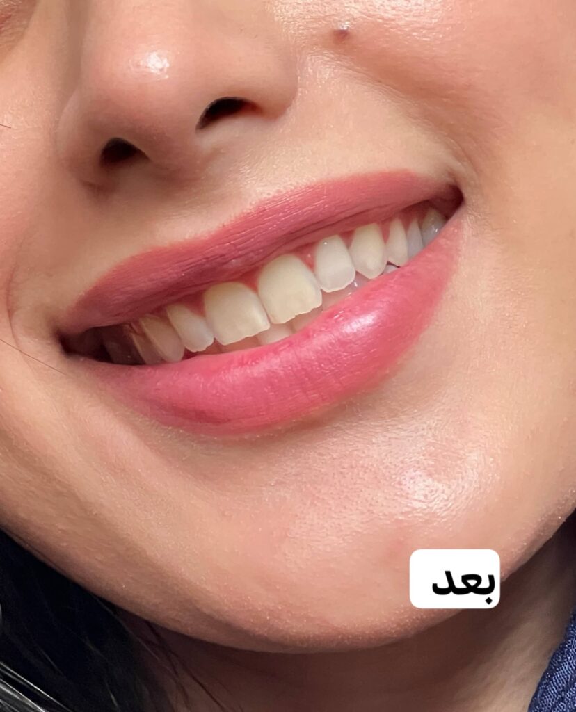 جرمگیر دندان لانبنا
