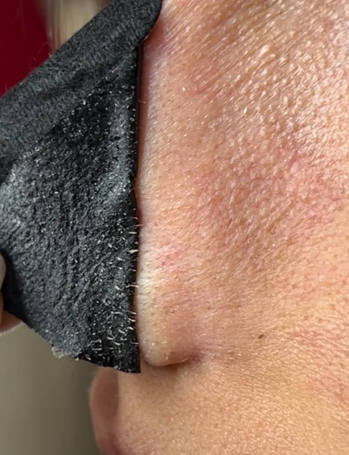 چسب جوش سر سیاه